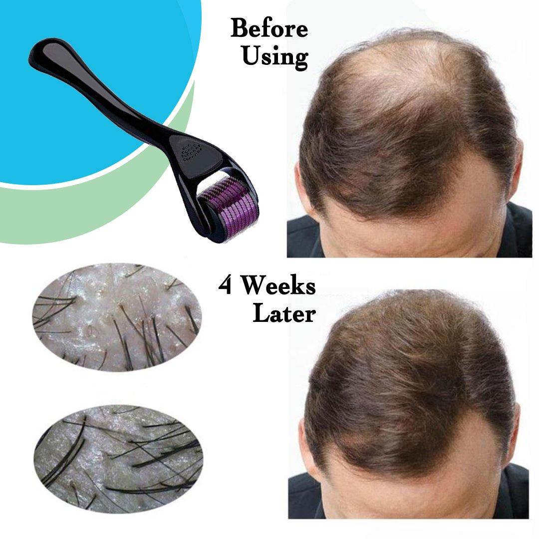 Derma Roller For Hair Growth And Scalp Care